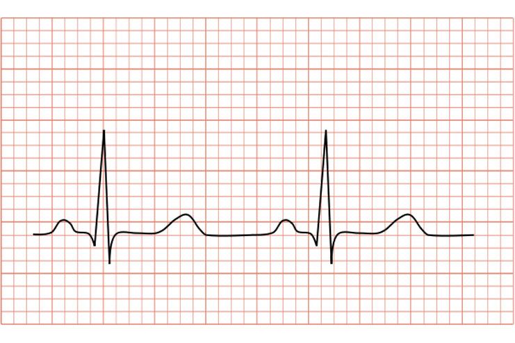 Electrocardiogram