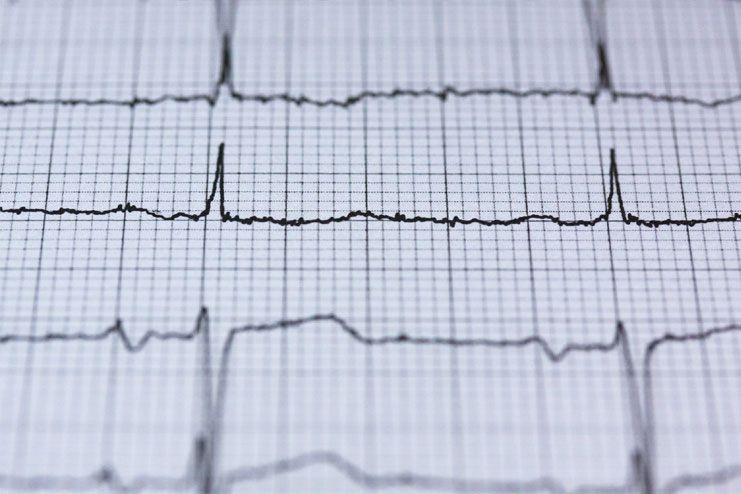 Electrocardiogram