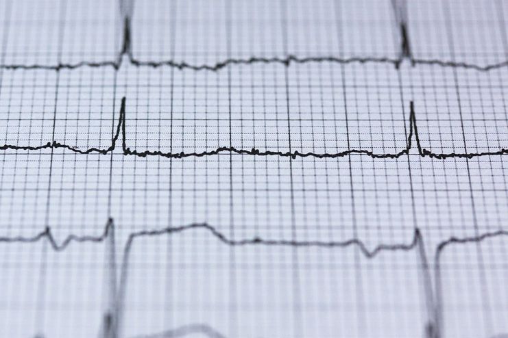 Electrocardiogram