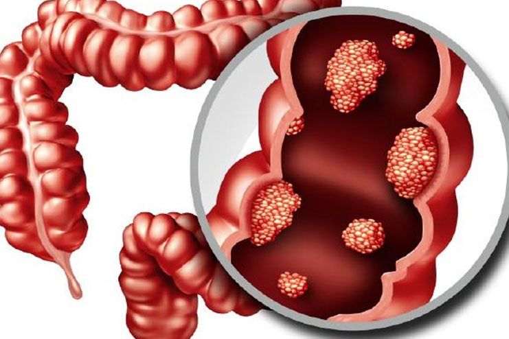 Familial adenomatous polyposis