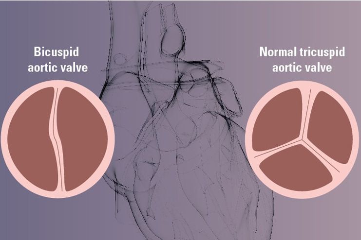 Impairments-in-the-valves