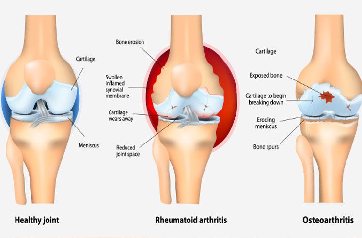 Osteoarthritis