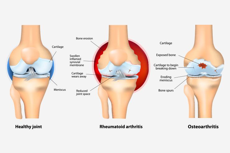 Osteoarthritis Vs Rheumatoid Arthritis