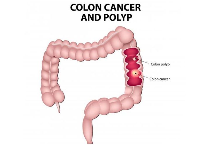 Precancerous growths