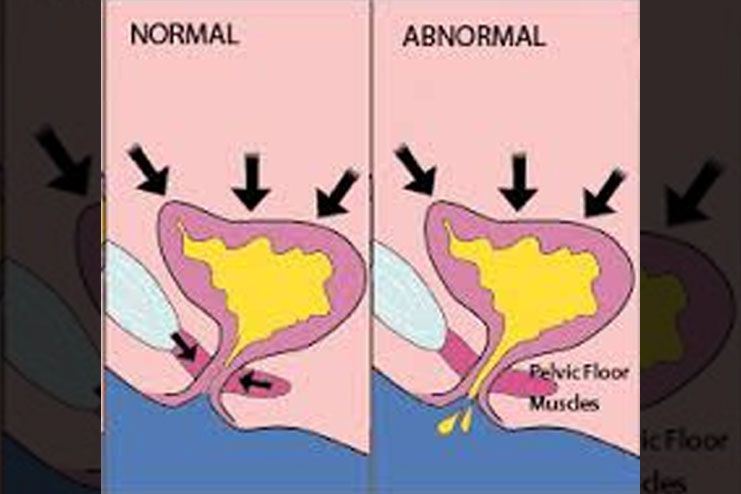 Risk factors Involved In Urinary Incontinence