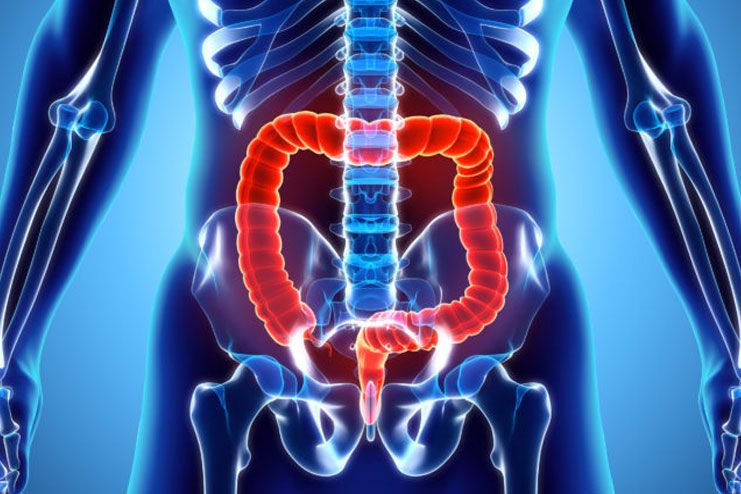 Stages of Colon Cancer