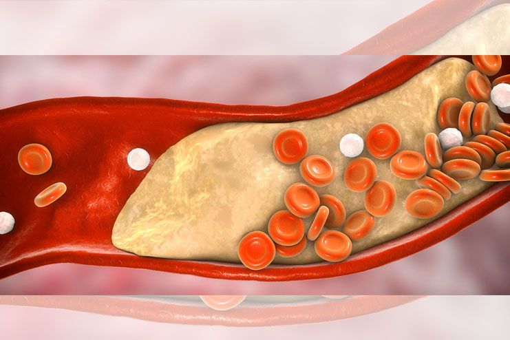 Types of Coronary Artery Disease