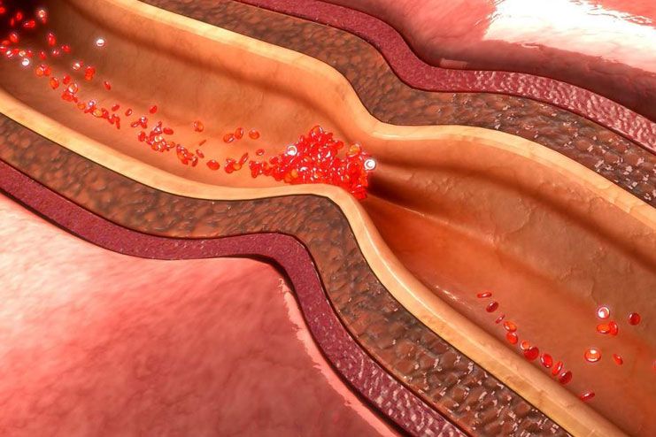 What is Coronary Artery Disease