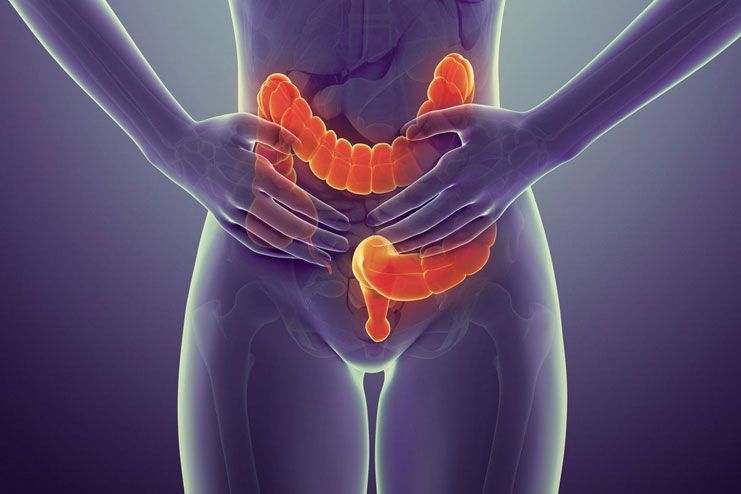 What is colon cancer