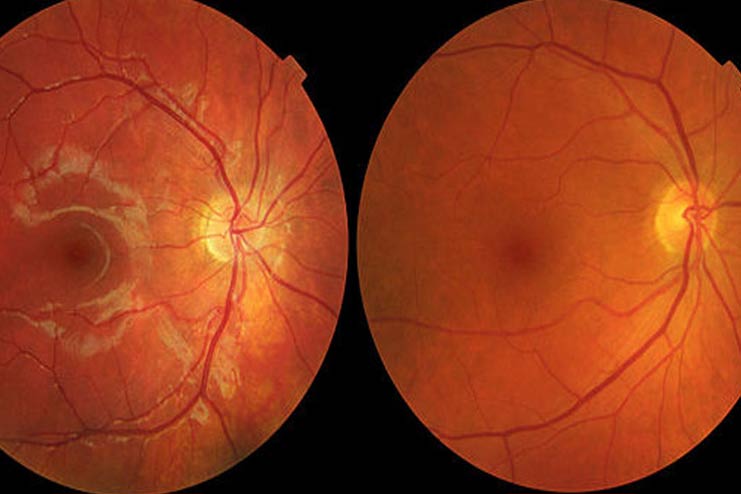 Macular-Degeneration