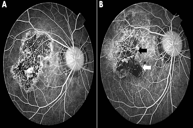 Retinal-Translocation