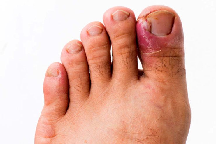 Risks of ingrown nails