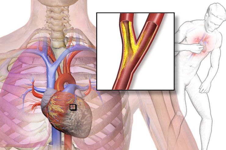 Stable Vs Unstable Angina