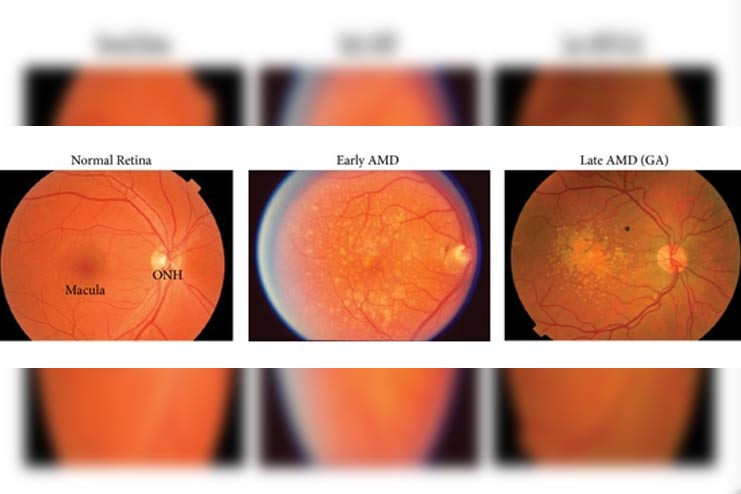 Stages-of-Macular