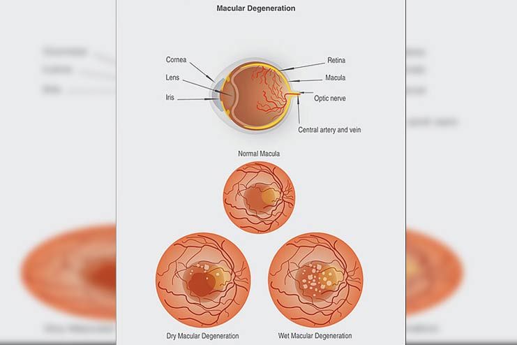 Types-of-Macular