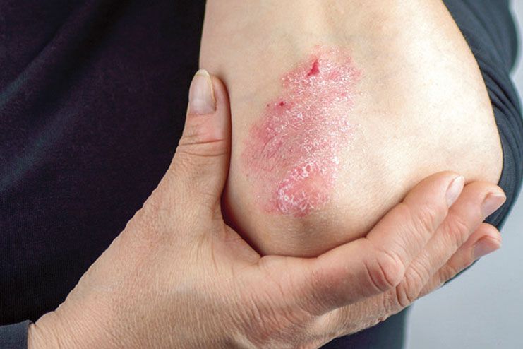 Psoriasis