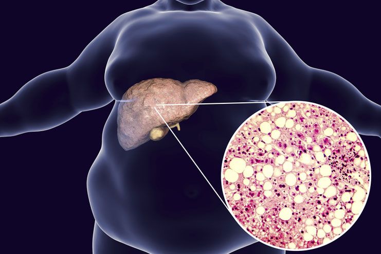 Risks of fatty liver