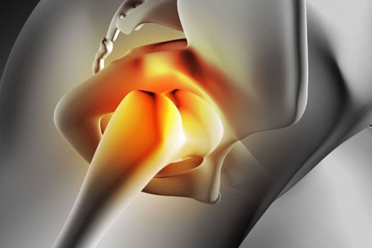 What are the causes of Hip Bursitis