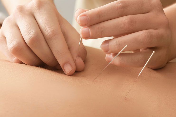 Acupuncture