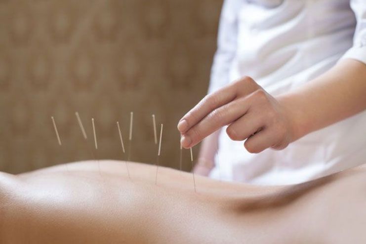 Acupuncture