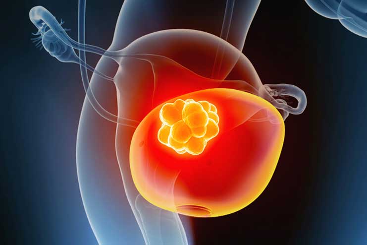 Bladder cancer