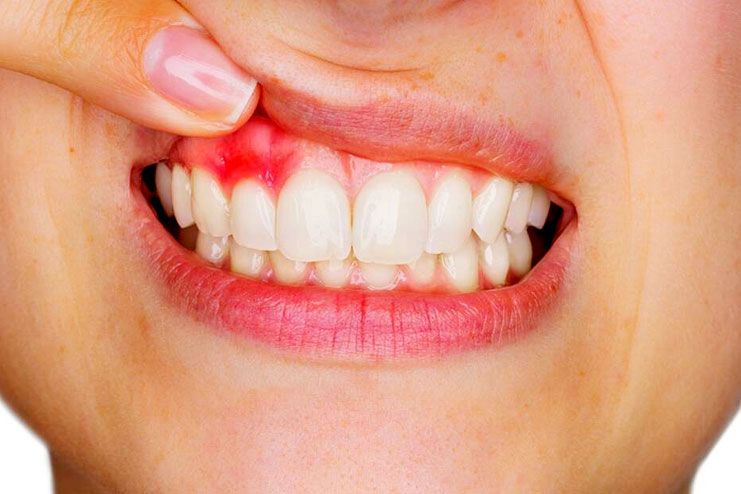 10 Home Remedies For Periodontitis – Get Rid Of Pyorrhea