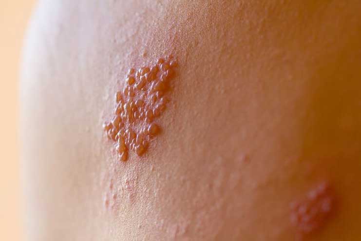 People who havent had chicken pox as a child don’t need shingles vaccine