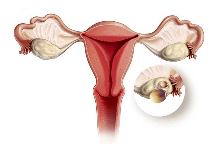 What is Polycystic Ovarian Syndrome