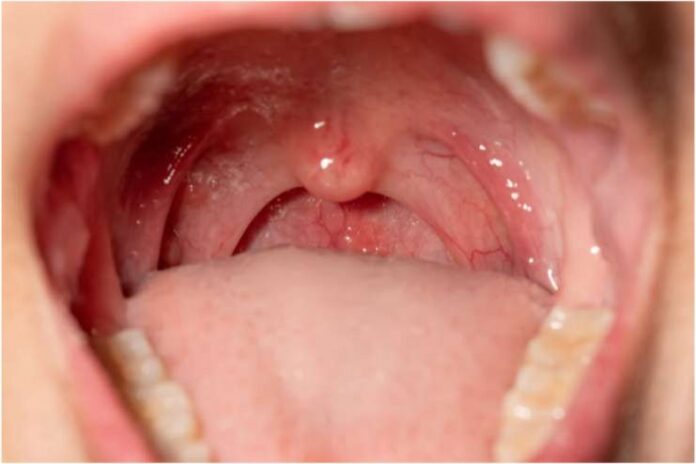 14 Natural Remedies for Uvulitis