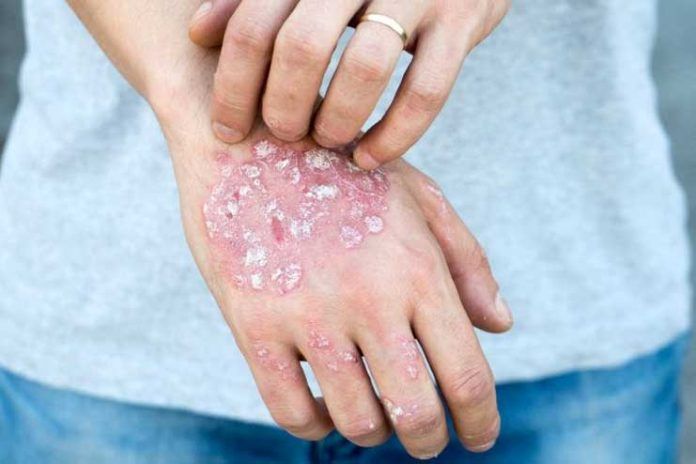 Fungal skin infection treatment