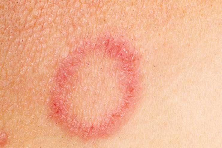 How long does a fungal skin infection last