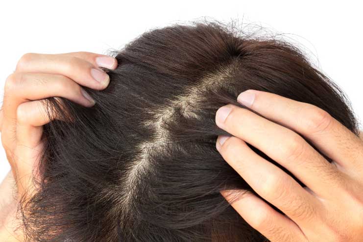 Improve scalp health