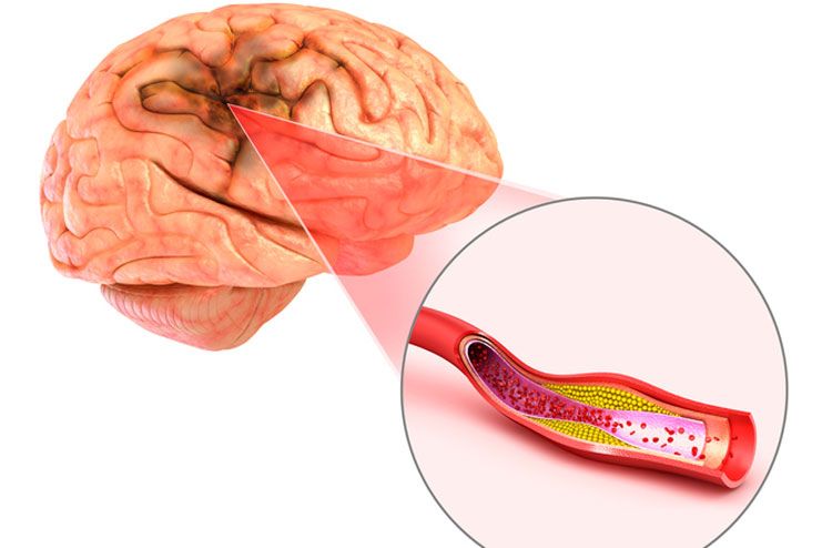 Ischemic stroke