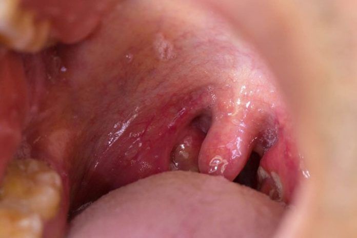 Natural remedies for uvulitis