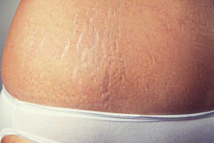 Reduces the appearance of the stretch marks