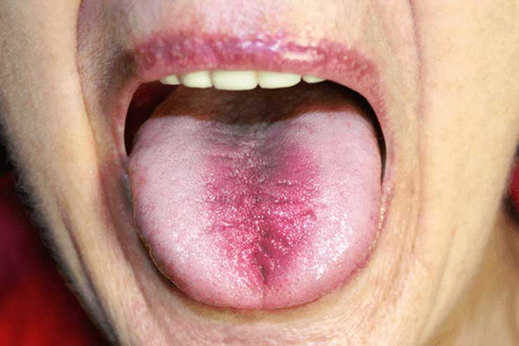 12 Home Remedies To Treat Tongue Burn – Get Better Relief Faster
