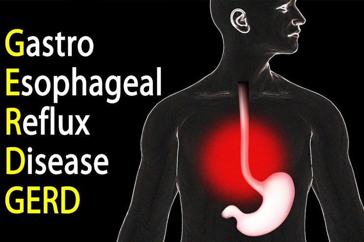 Burning Sensation - Gastroesophageal reflux disease