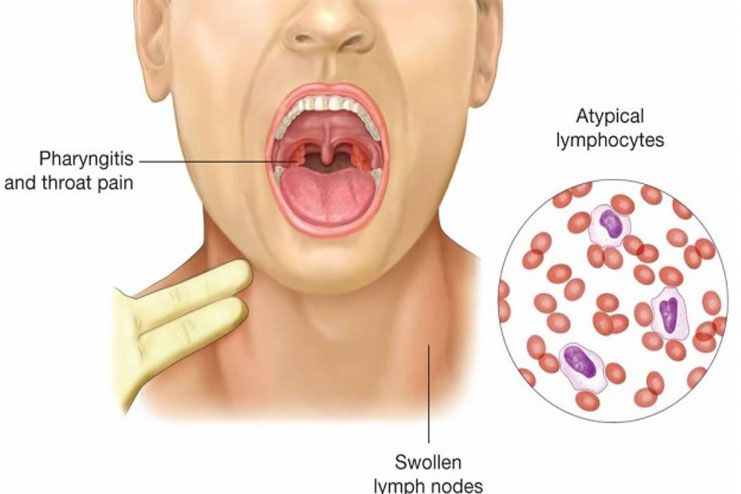 Burning Sensation - Mononucleosis