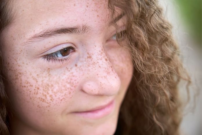 What Are Freckles