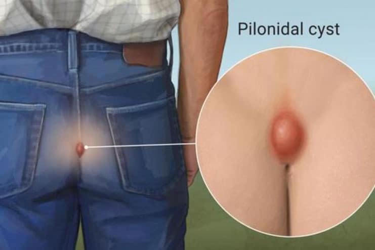 What causes Pilonidal cyst