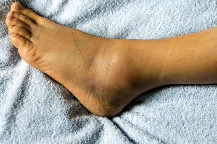 What is Edema