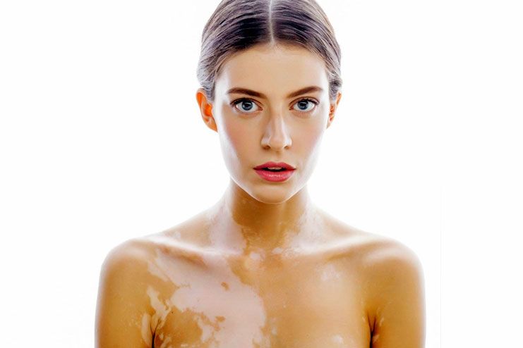 What is Vitiligo