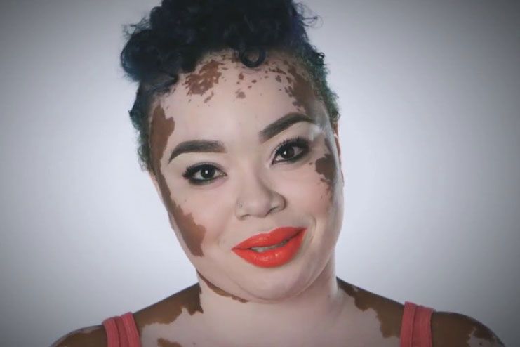 17 Home Remedies For Vitiligo – Even The Blotchy Skin