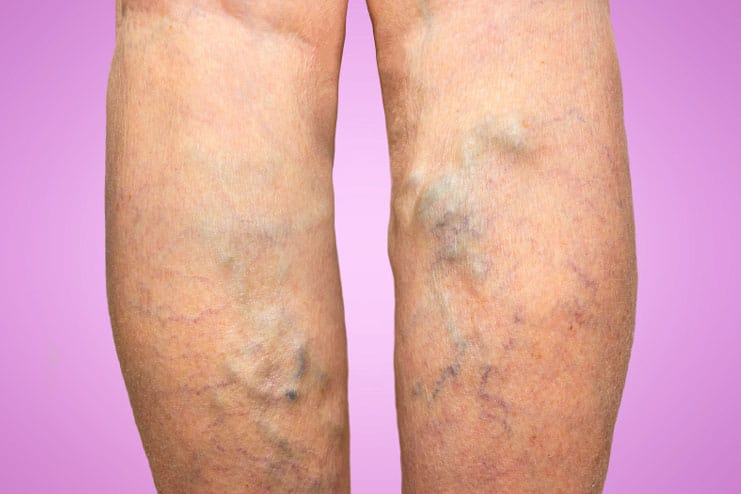 Amazing remedy for varicose veins