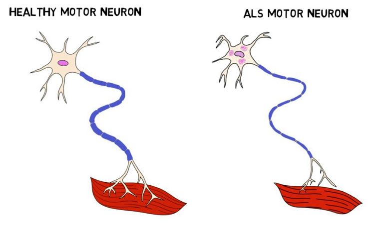 Amyotrophic lateral sclerosis