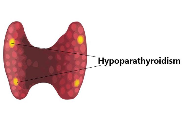 Hypoparathyroidism