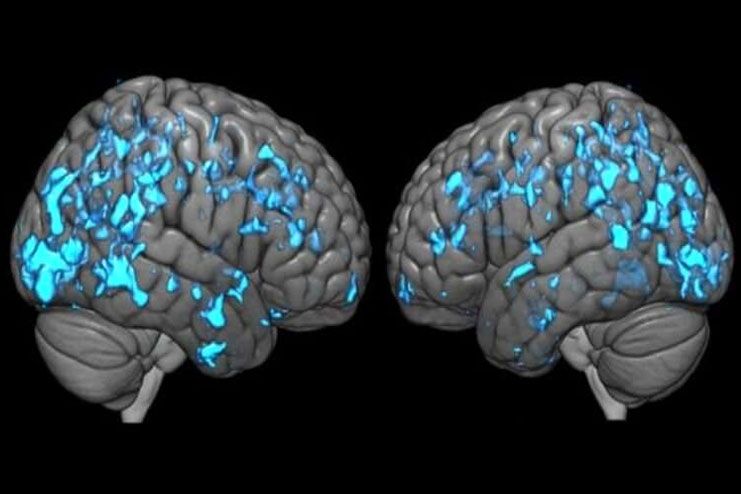 Parkinsons disease