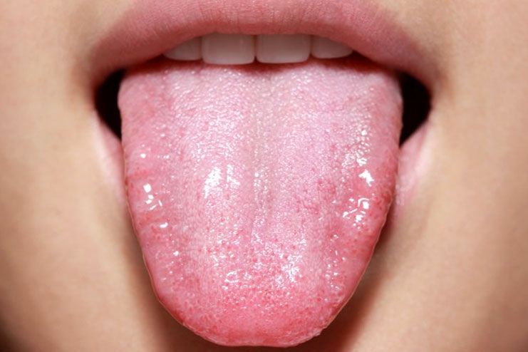 Types of Tongue Problems