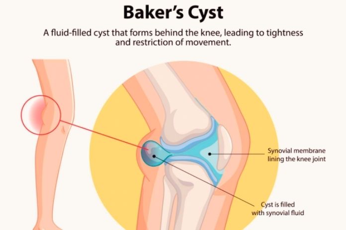 What Causes a Bakers Cyst