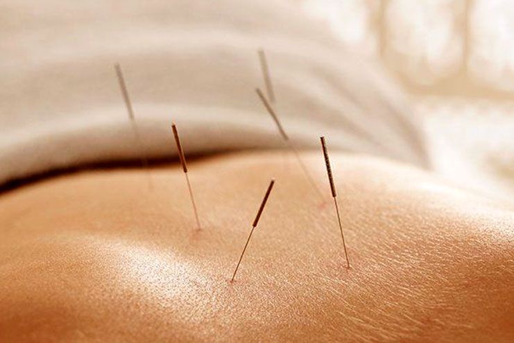 Acupuncture